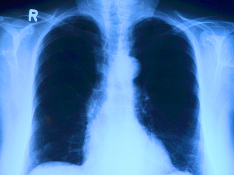 WorldTimes Online-Lunge-Röntgenbild-XRAY